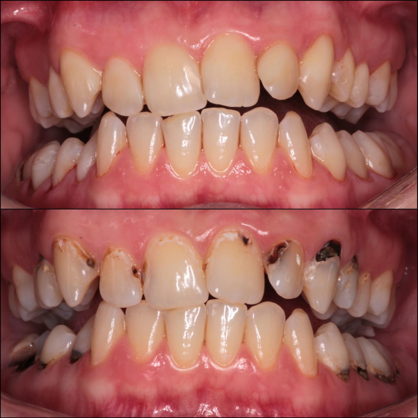 Obturatii rasini compozite