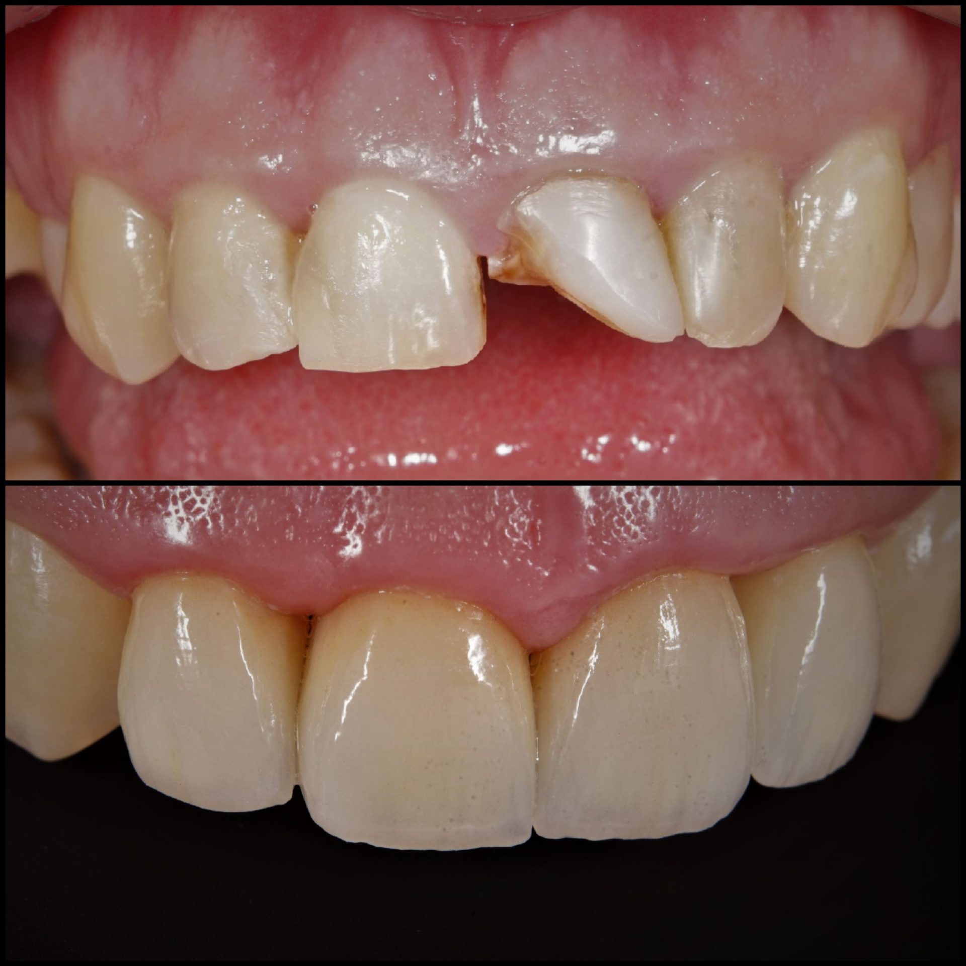 Coroane ceramica pe zirconiu & fatete