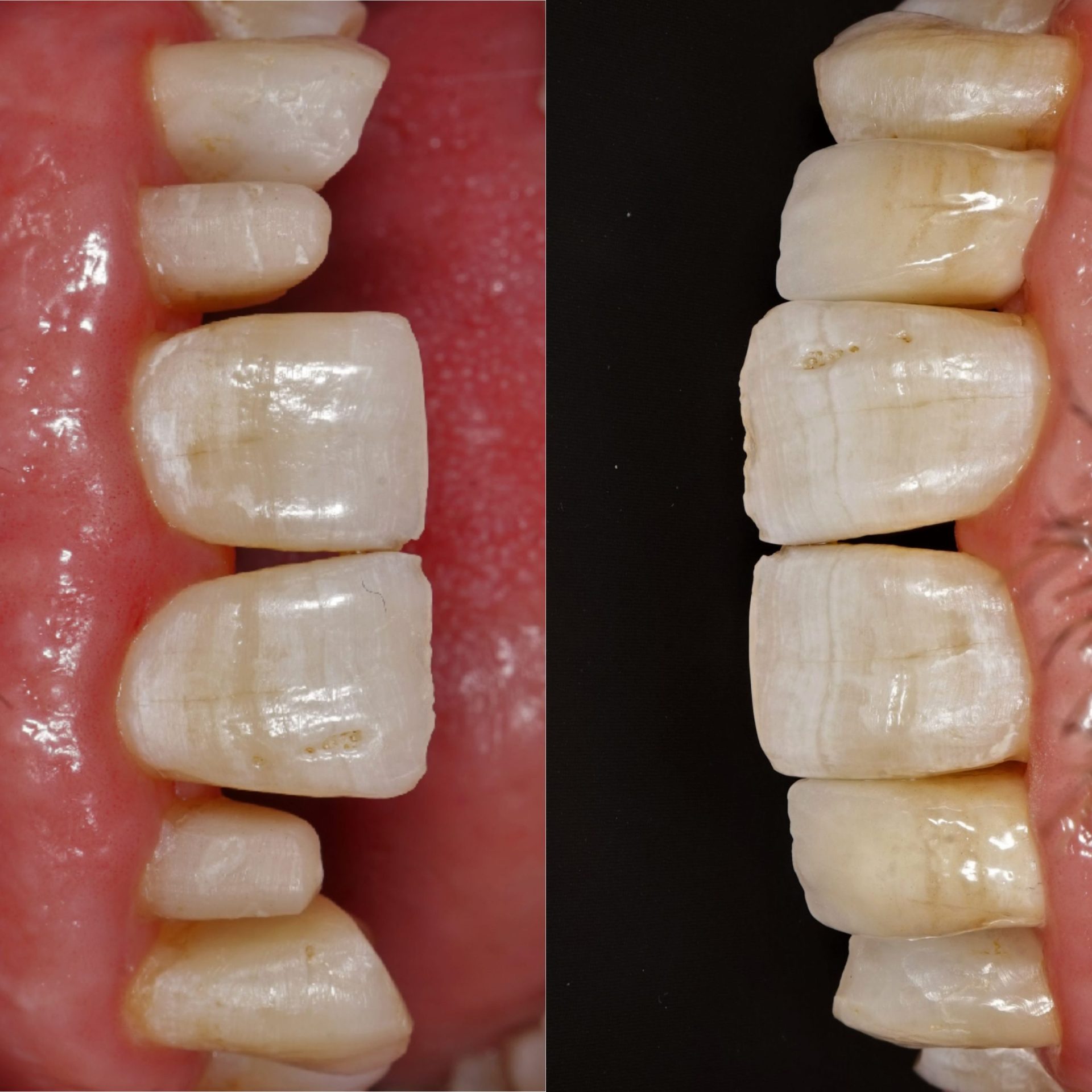Coroane integral ceramice