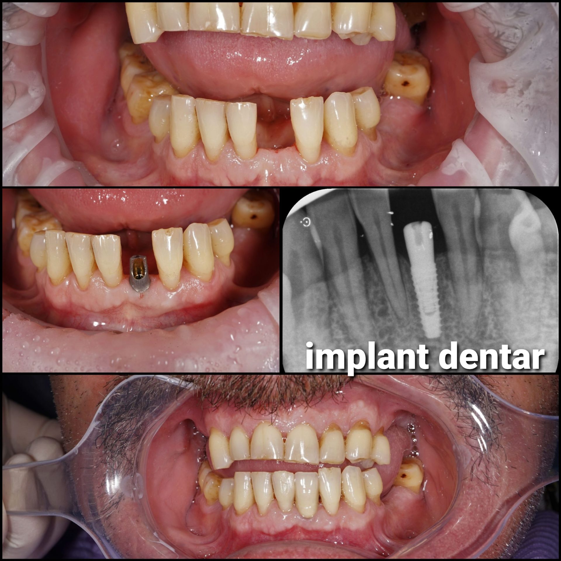 Implant dentar