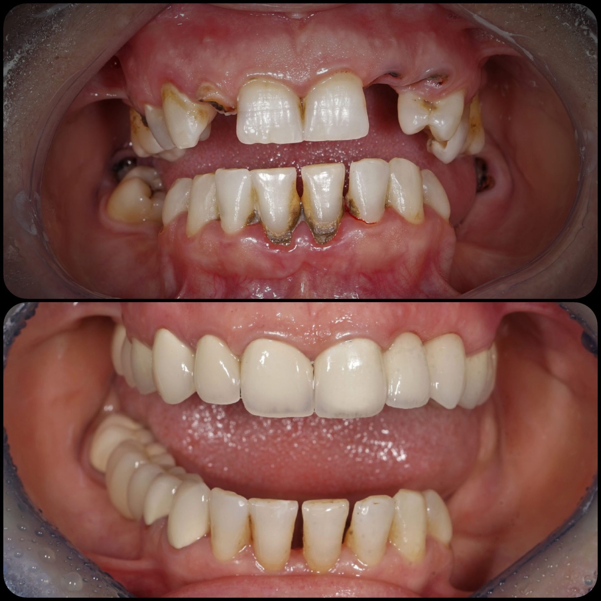 Lucrari fixe metalo-ceramice